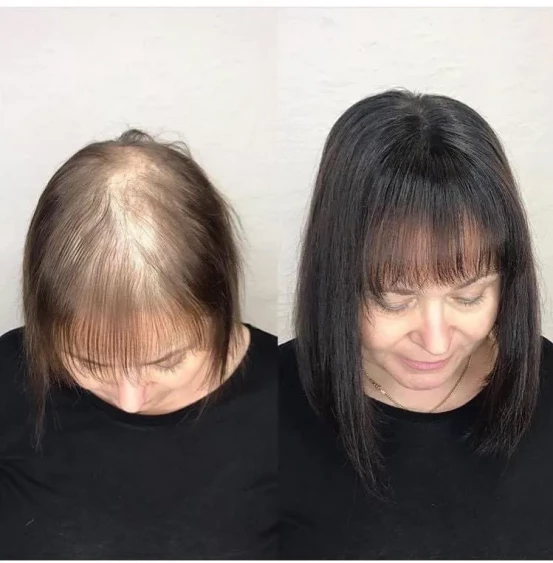 Behandeling alopecia Sint-Niklaas, Antwerpen